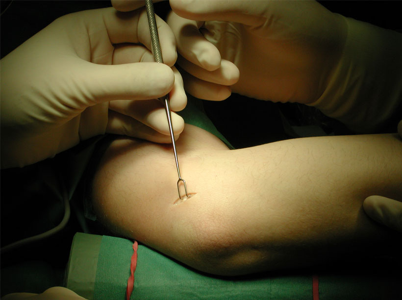 The incision The incision