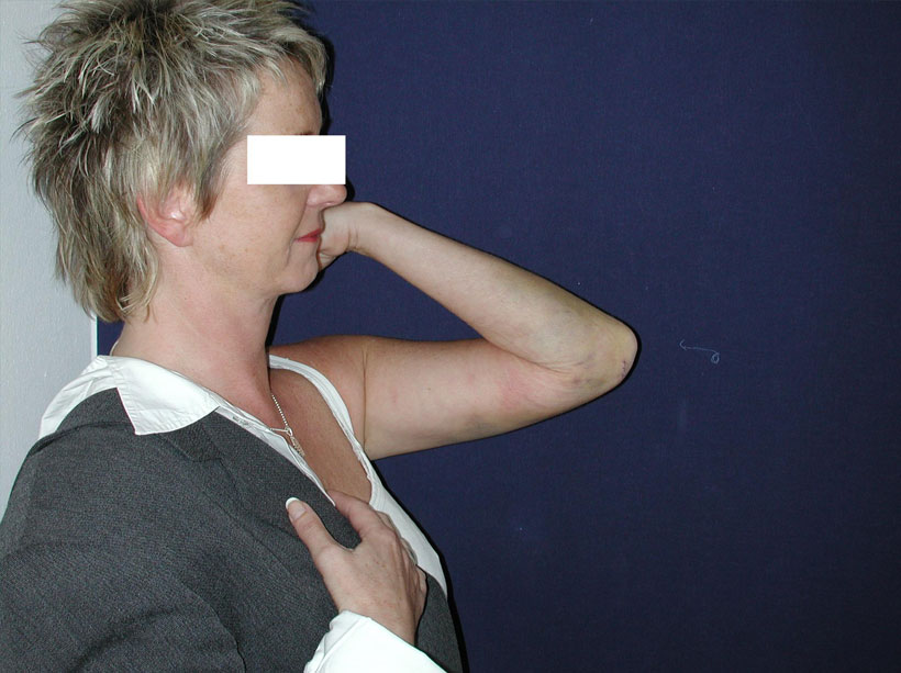 The patient 2 days after surgery – full movement The patient 2 days after surgery – full movement